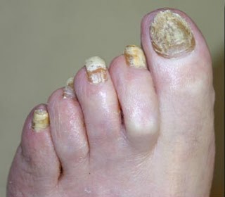 Nail fungus is a condition that affects many millions worldwide